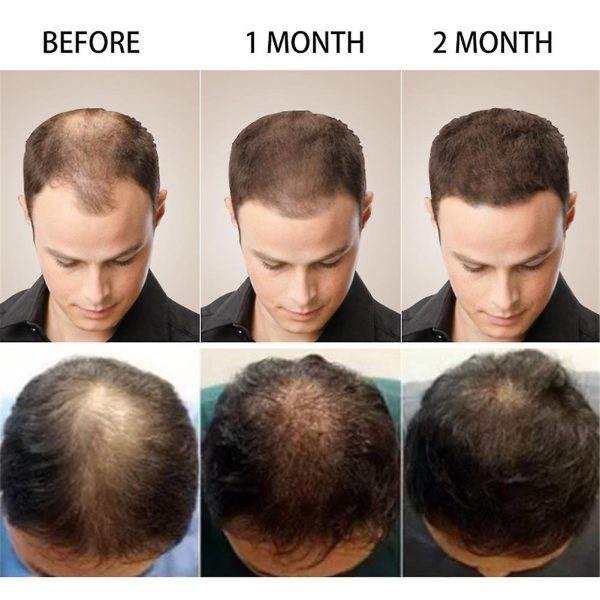 Anti Hair Fall Control Serum for Men & Women - Hair Growth Essence Oil Hair Care Serum