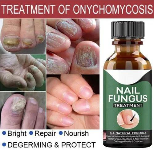 Fast Nail Fungal Treatments Nail Repair Essences Serum Care