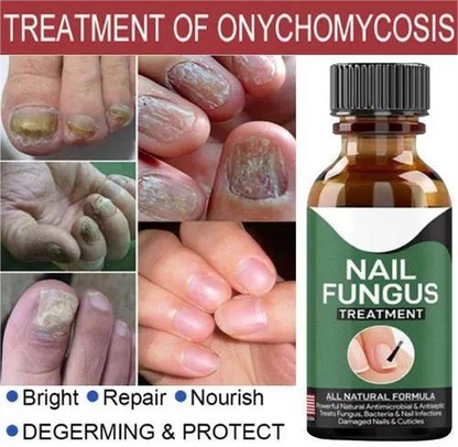 Fast Nail Fungal Treatments Nail Repair Essences Serum Care